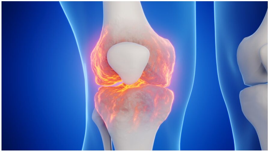 무릎낭종