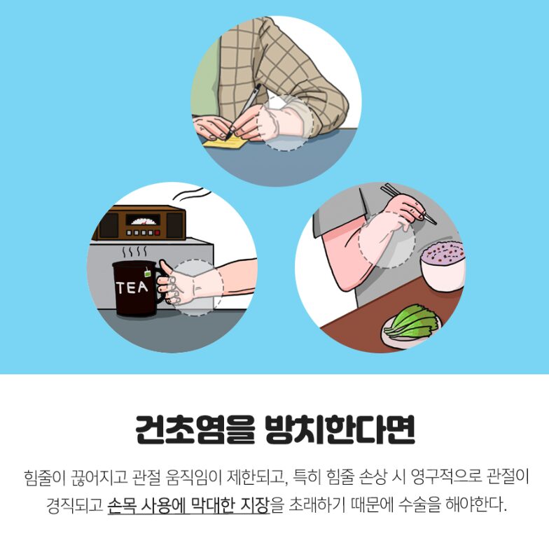 엄지손가락 통증 원인 드퀘르벵 치료, 진짜 수부정형외과라면 내시경 통해 치료합니다