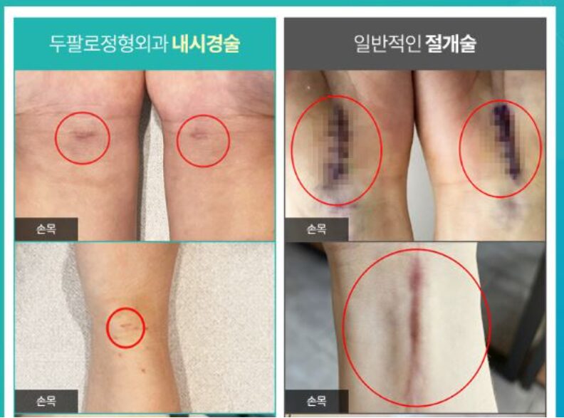 손목터널증후군 무시했다간 돌이킬 수 없는 결과를 초래할 수 있습니다