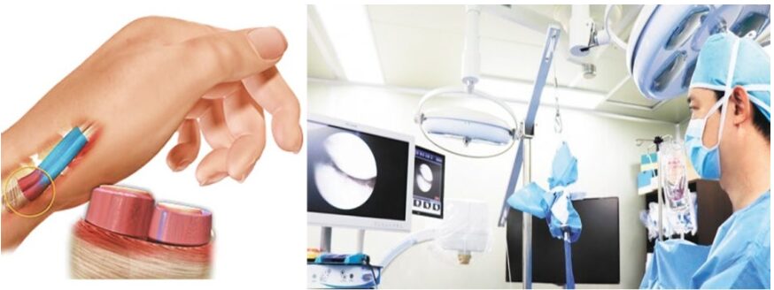 엄지손가락 통증 원인 드퀘르벵 치료, 진짜 수부정형외과라면 내시경 통해 치료합니다