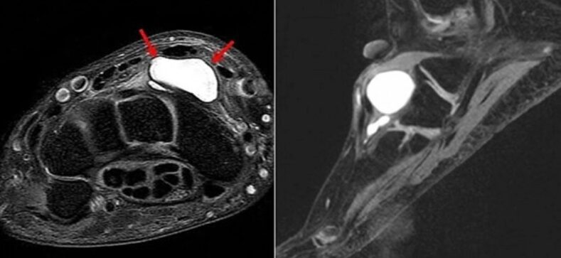 발산역정형외과 손목 결절종 수술해야 할까? 증상과 치료 기준 완벽 정리