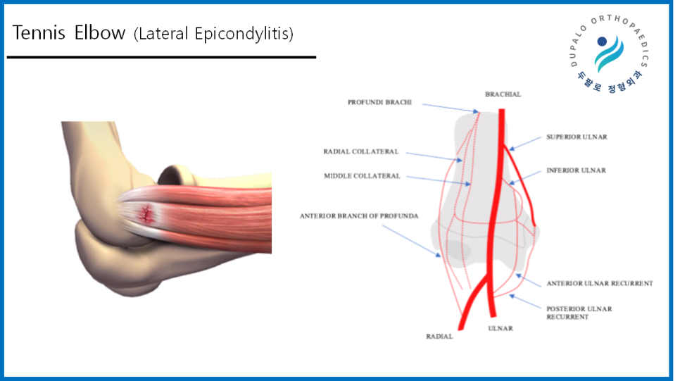 팔꿈치통증 골프·테니스엘보 진단부터 치료방법까지 총정리!