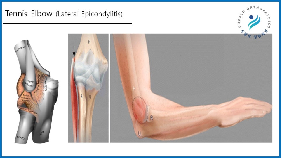 팔꿈치통증 골프·테니스엘보 진단부터 치료방법까지 총정리!