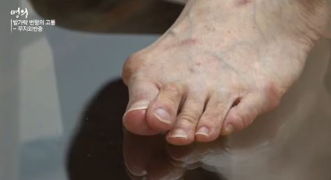 마곡정형외과, 무지외반증 예방과 치료방법 모르면 독입니다