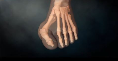 마곡정형외과, 무지외반증 예방과 치료방법 모르면 독입니다