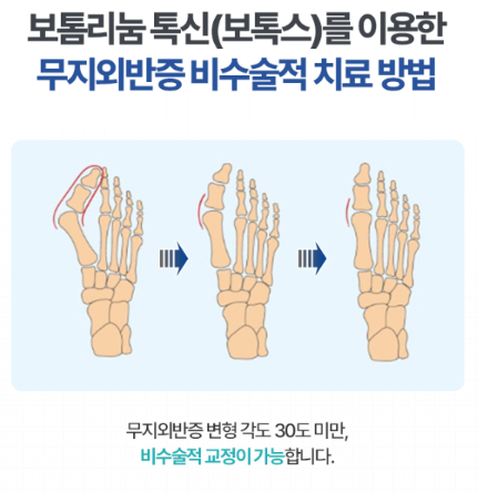 마곡정형외과, 무지외반증 예방과 치료방법 모르면 독입니다