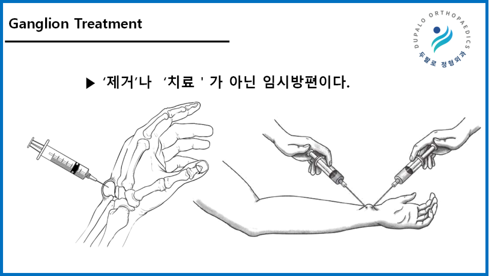 손목결절종수술 병원은 내시경 원스톱 수부정형외과로