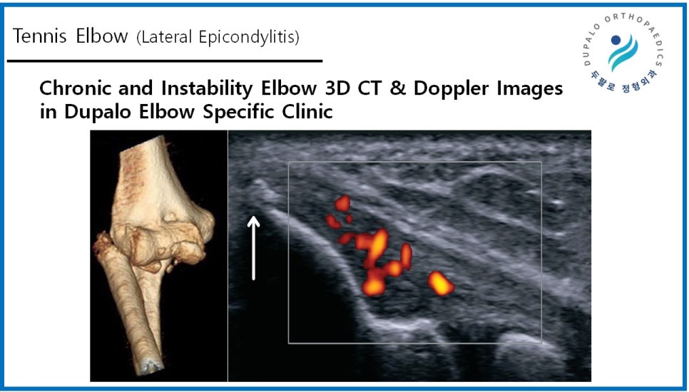 테니스엘보 수술은 입원·흉터·기브스 필요 없습니다