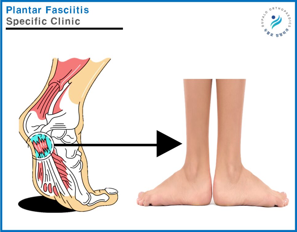 발산역 발바닥통증 족저근막염 치료, 세포재생 시술이 도움이 될까?