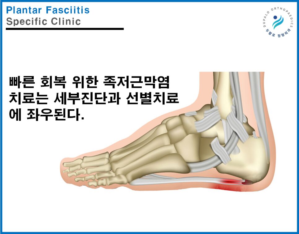 발산역 발바닥통증 족저근막염 치료, 세포재생 시술이 도움이 될까?