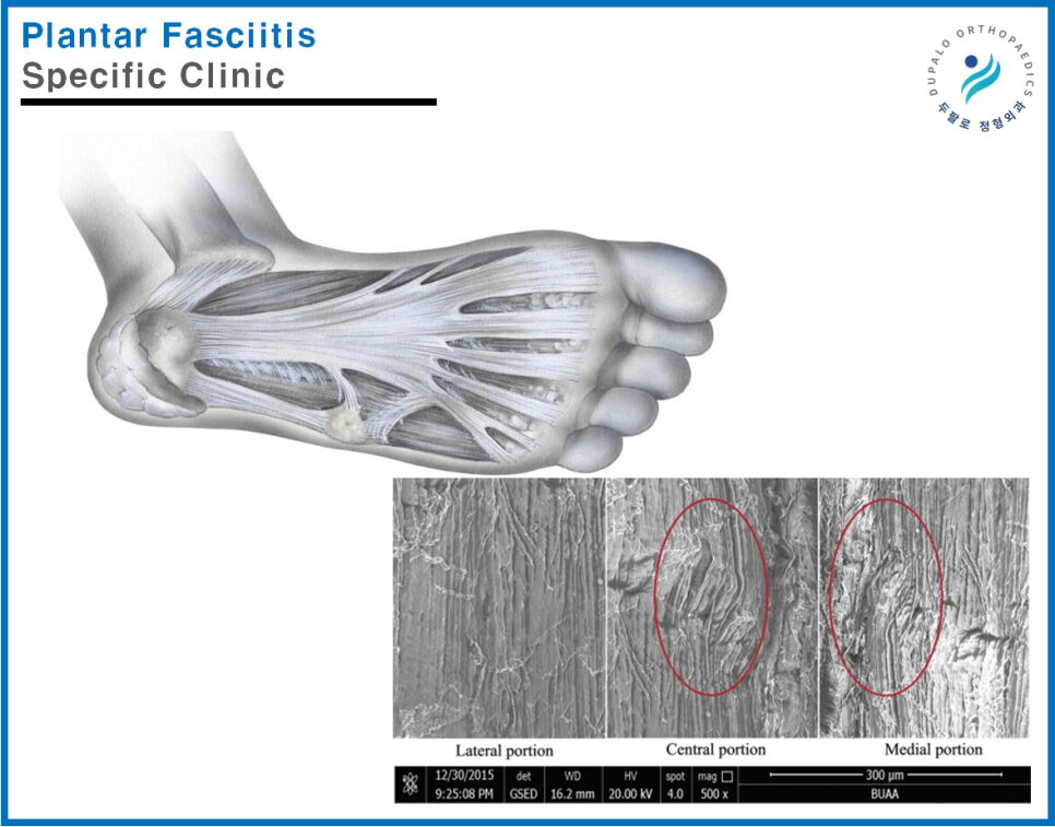 발산역 발바닥통증 족저근막염 치료, 세포재생 시술이 도움이 될까?