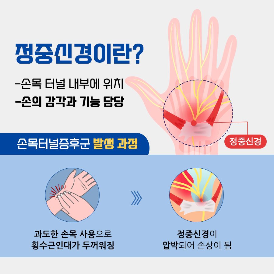 손목터널증후군 수술방법, 내시경과 절개의 회복부담 차이는 어느 정도일까?