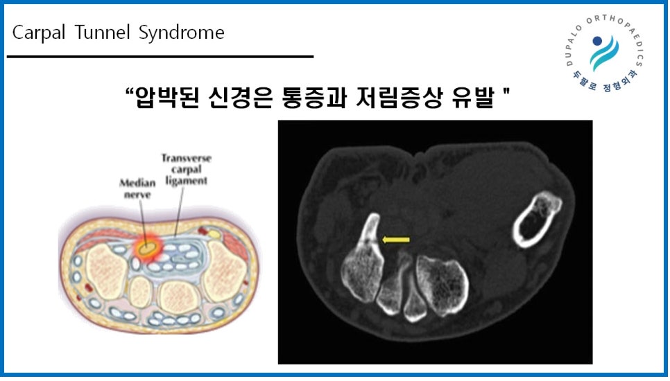 손목터널증후군 주사, 파스는 효과가 없는 이유?!