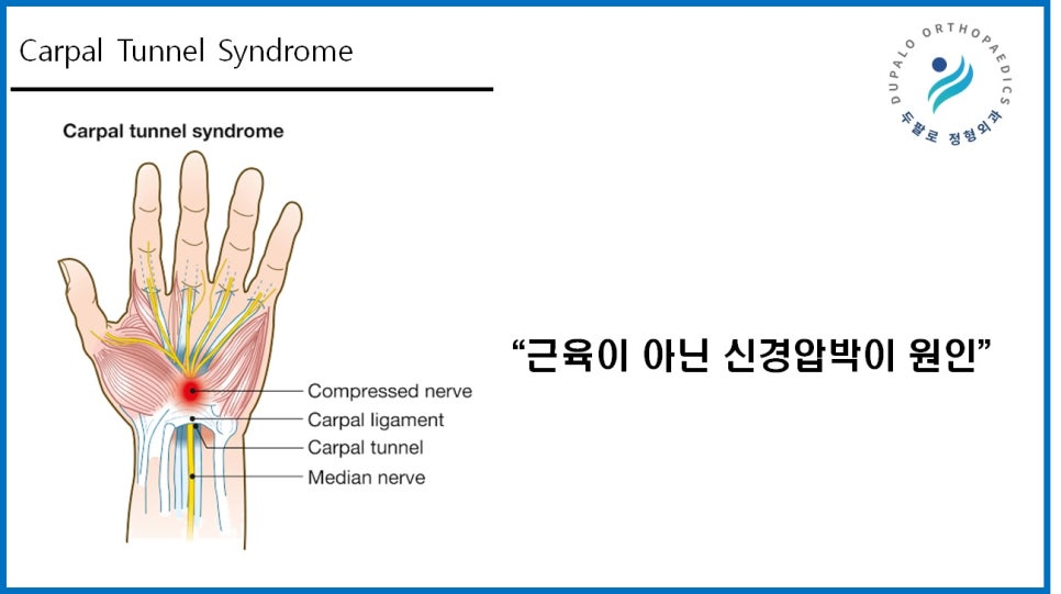 손목터널증후군 주사, 파스는 효과가 없는 이유?!