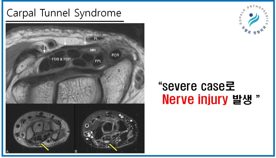 손목터널증후군 주사, 파스는 효과가 없는 이유?!