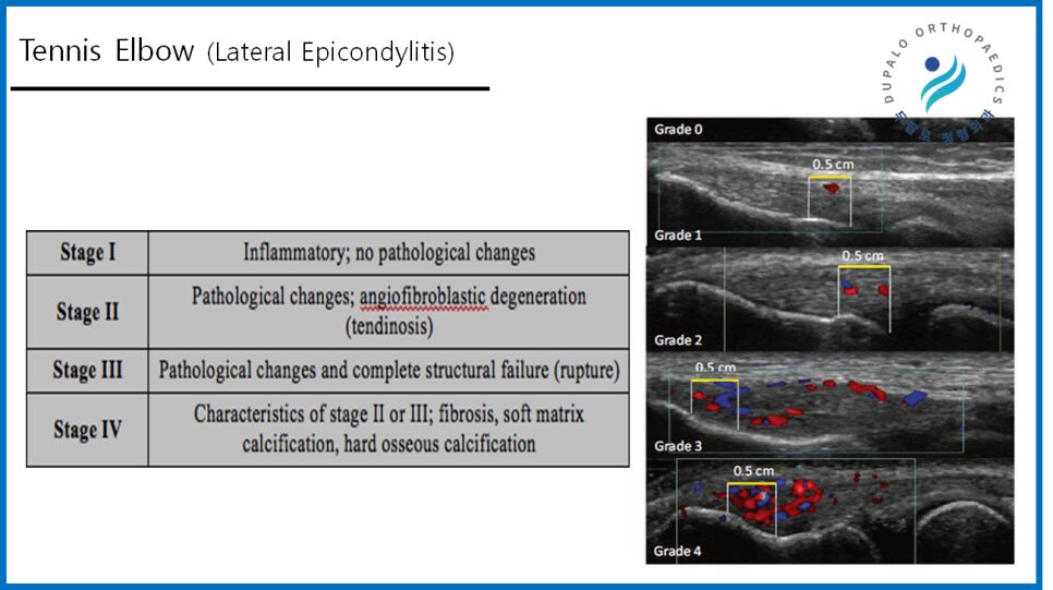 테니스엘보 수술은 입원·흉터·기브스 필요 없습니다｜회복 빠른 최신 치료법 정리