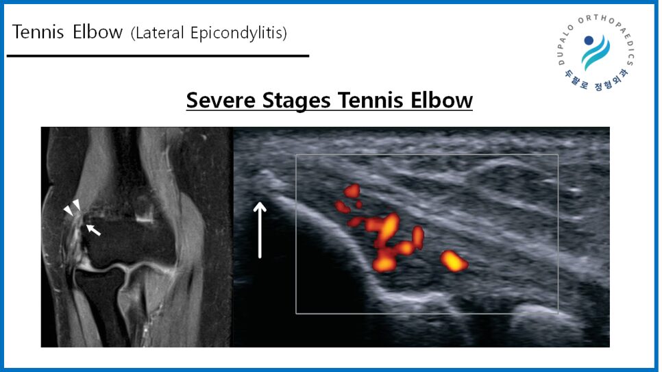 테니스엘보 수술은 입원·흉터·기브스 필요 없습니다｜회복 빠른 최신 치료법 정리