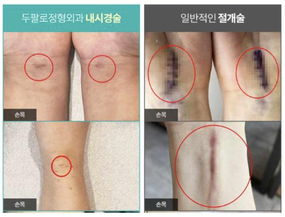 강서구정형외과 손목이 찌릿찌릿 식당에서 일하는 분들 손목터널증후군 조심하세요