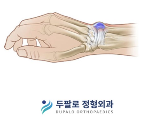 손목 혹으로 고생 중이신가요 강서구 정형외과 하승주 원장의 해결책