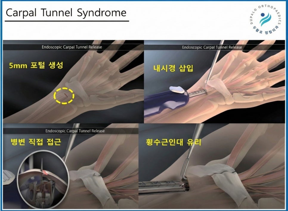 손목터널증후군 진단부터 내시경유리술까지