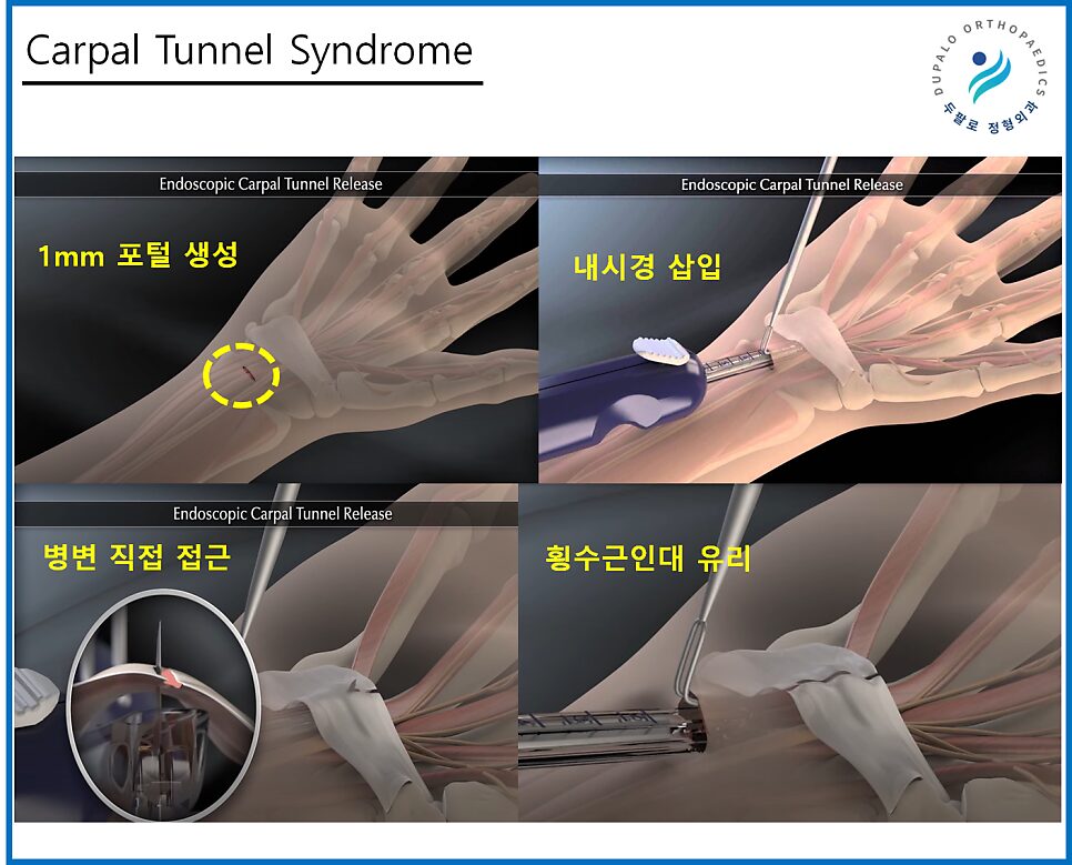 손목터널증후군 치료, 수술 비중이 높은 이유와 내시경 유리술 치료 방법