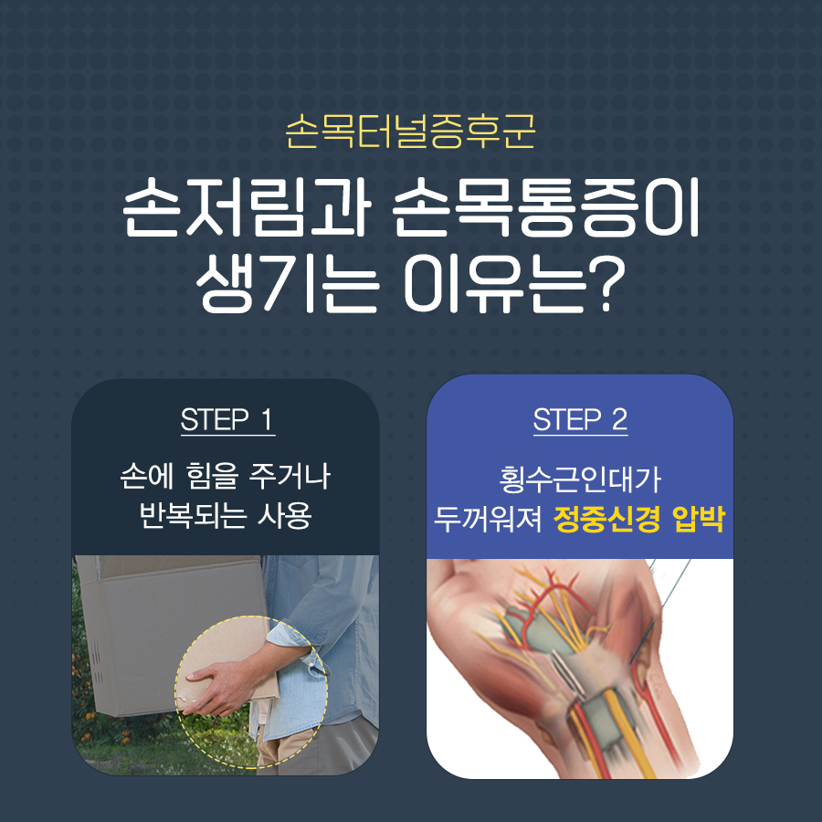 손목터널증후군 치료, 수술 비중이 높은 이유와 내시경 유리술 치료 방법